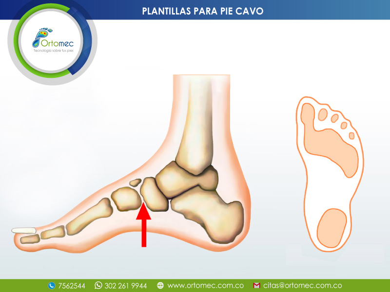 PLANTILLAS ortopedicas pies Cavos