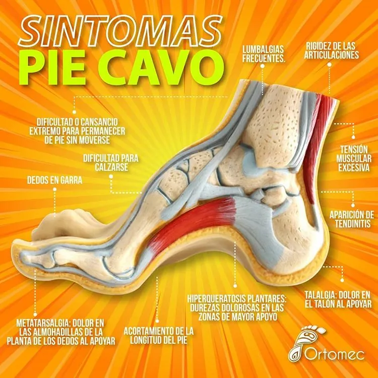 Plantillas para pie cavo
