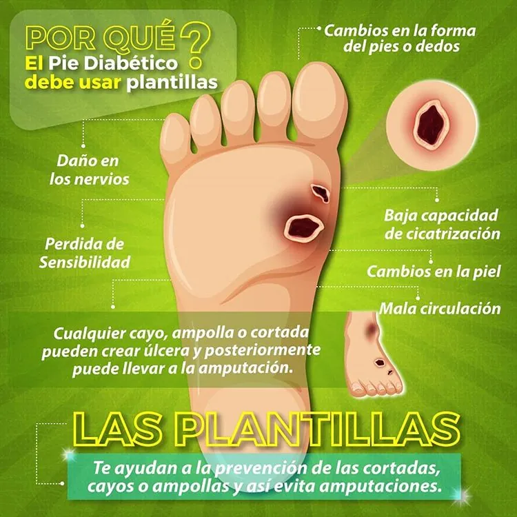 Plantillas para pie diabético