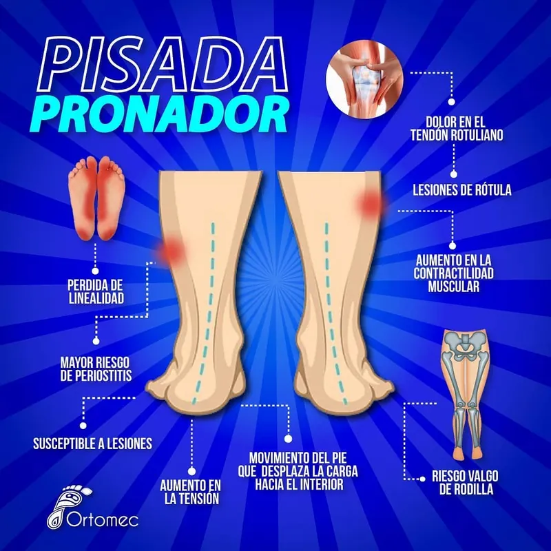 Plantillas para fascitis plantar