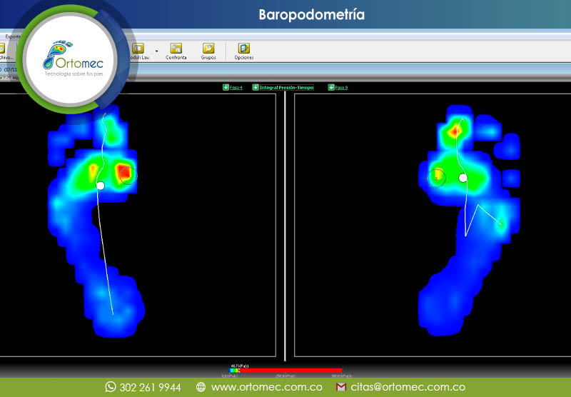 baropodometría Bogotá